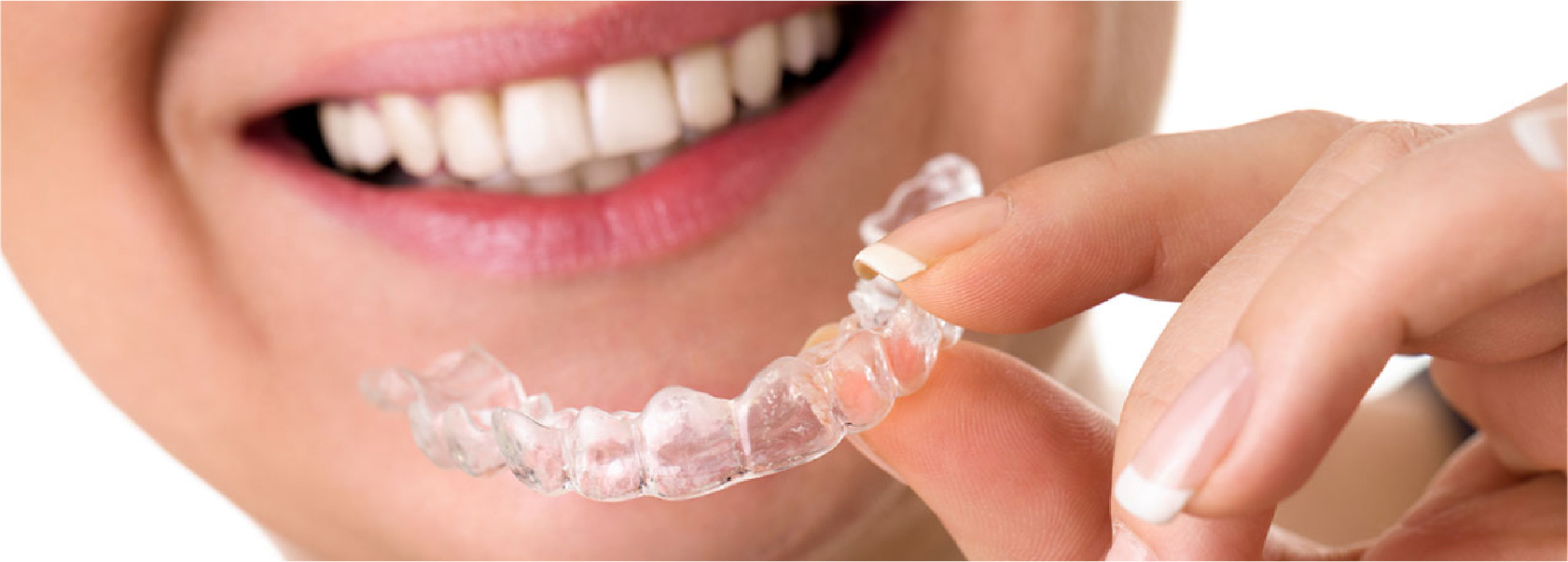 Invisalign tray being put in mouth