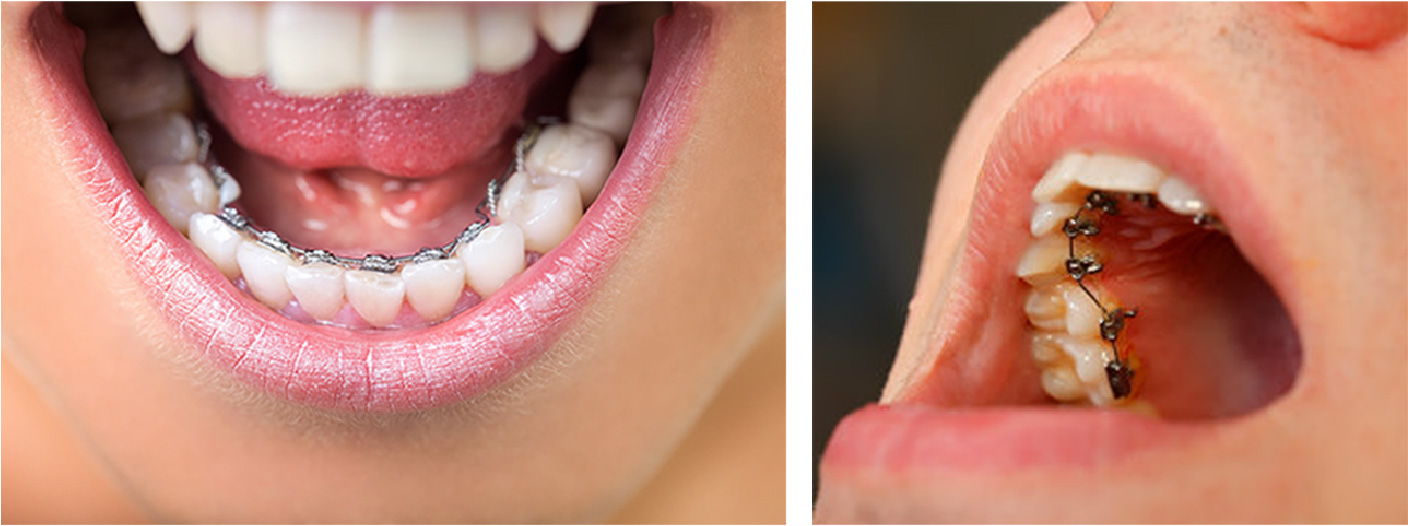 Hidden Braces - Braces shown on the backside of teeth, upper and lower