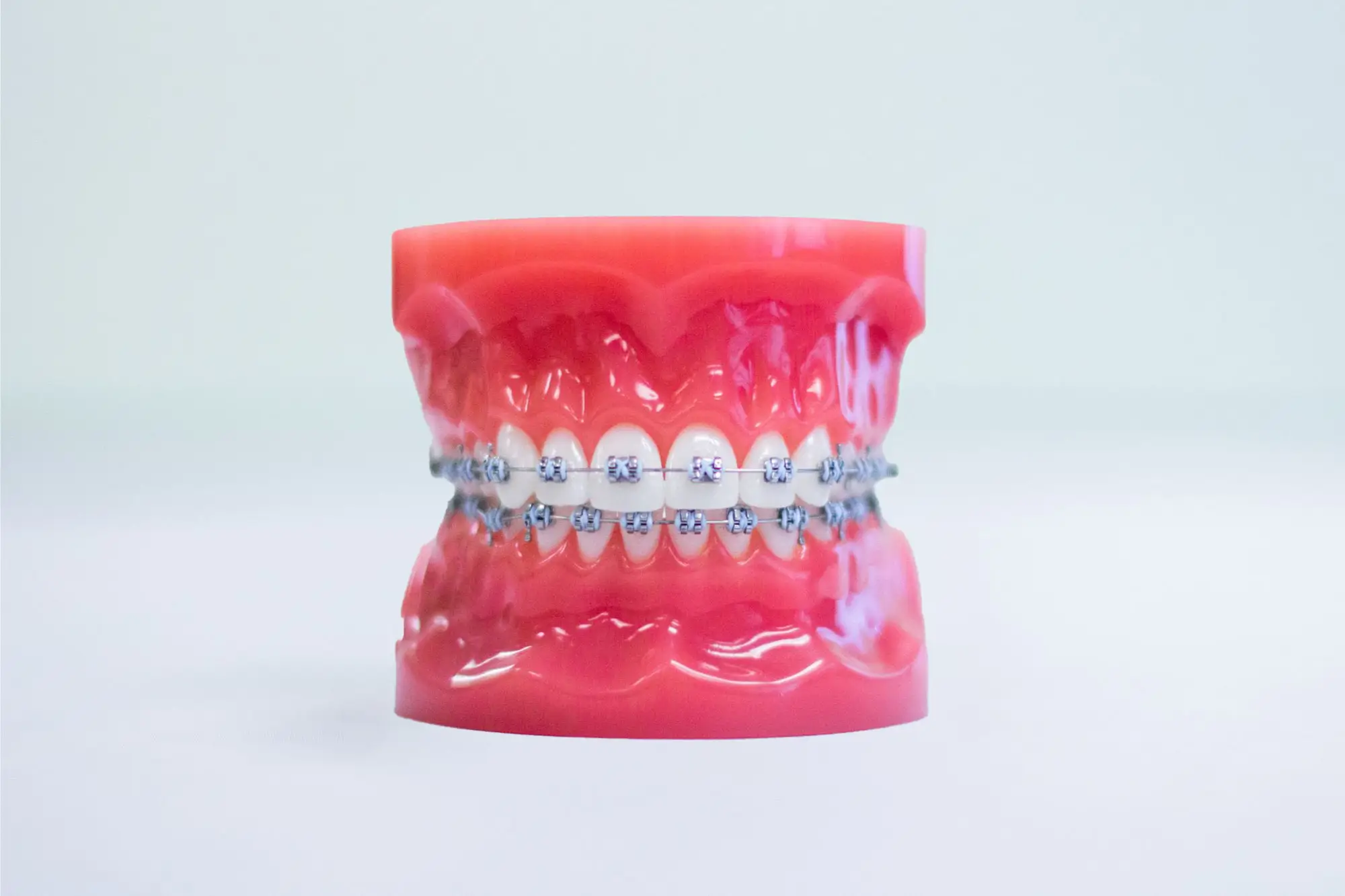 metal-braces