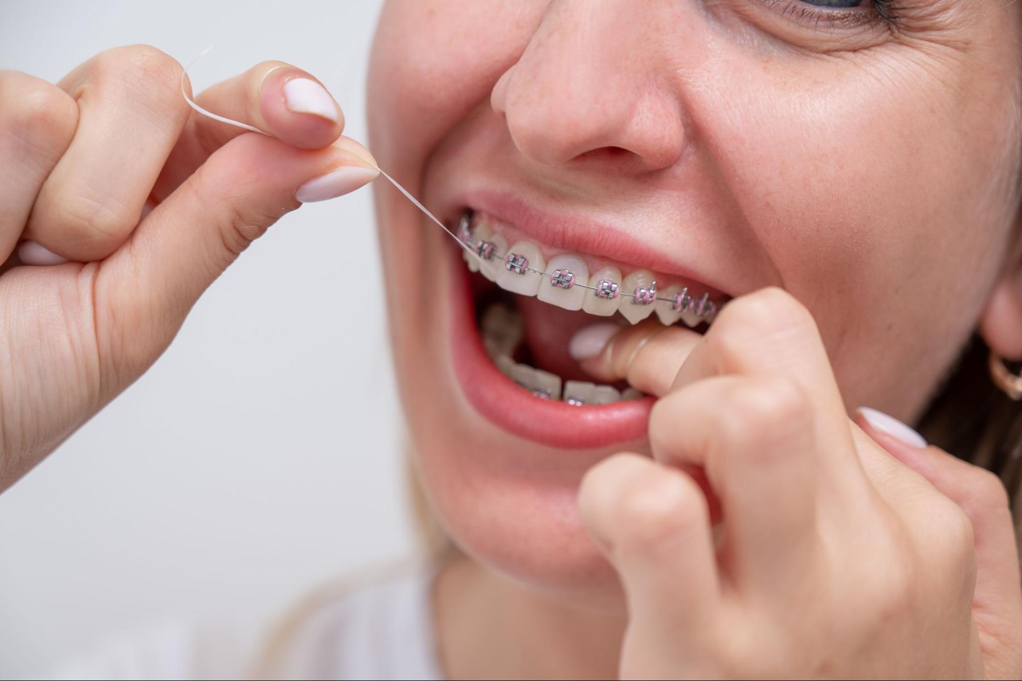 How To Keep Your Braces Clean and Teeth Healthy