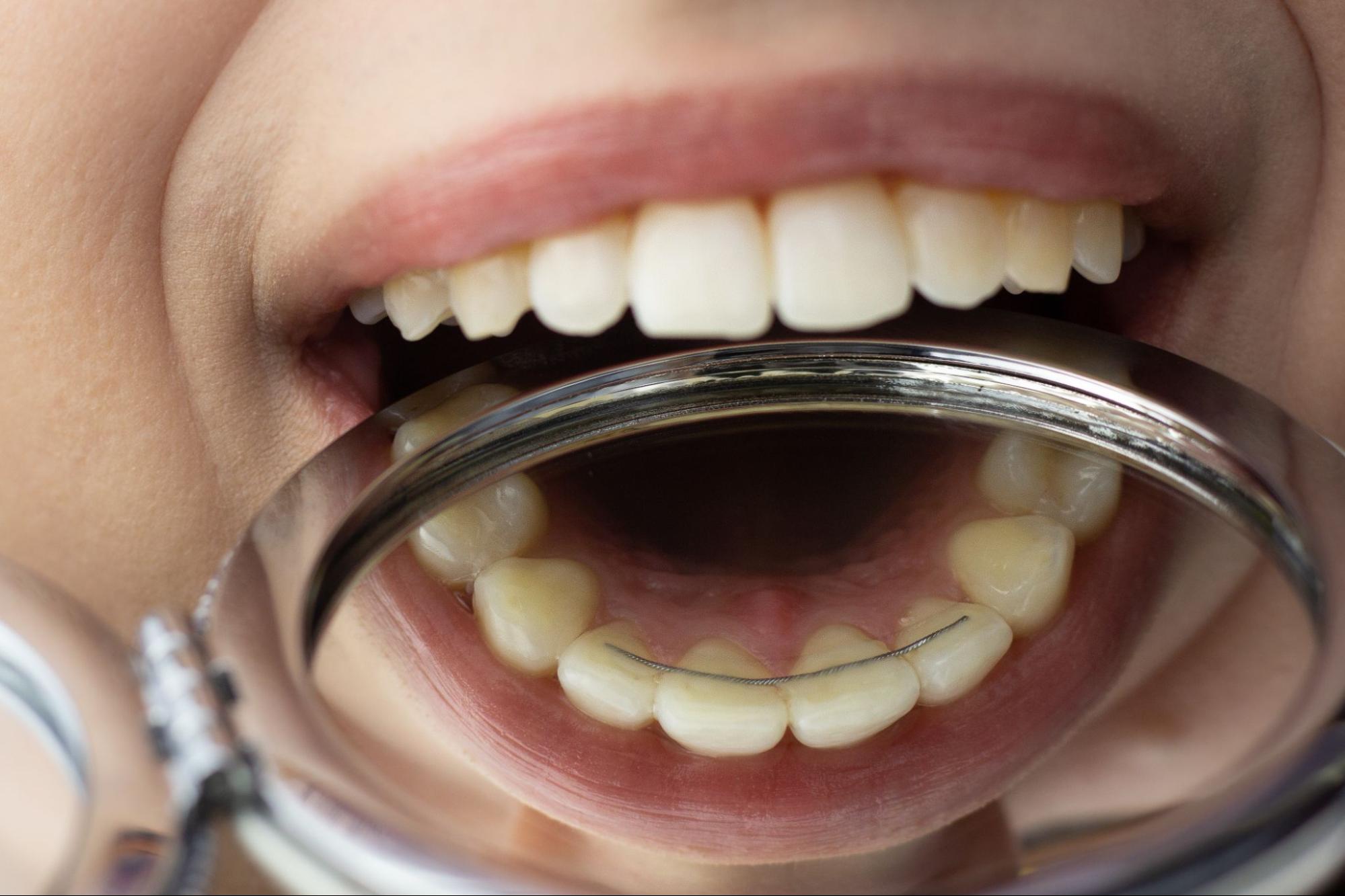 Do I Need a Bonded Retainer After Braces?